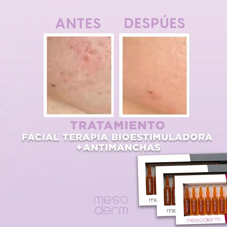 Tratamiento Facial Terapia Bioestimuladora + Antimanchas