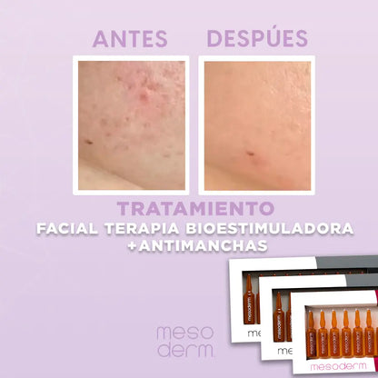 Tratamiento Facial Terapia Bioestimuladora + Antimanchas
